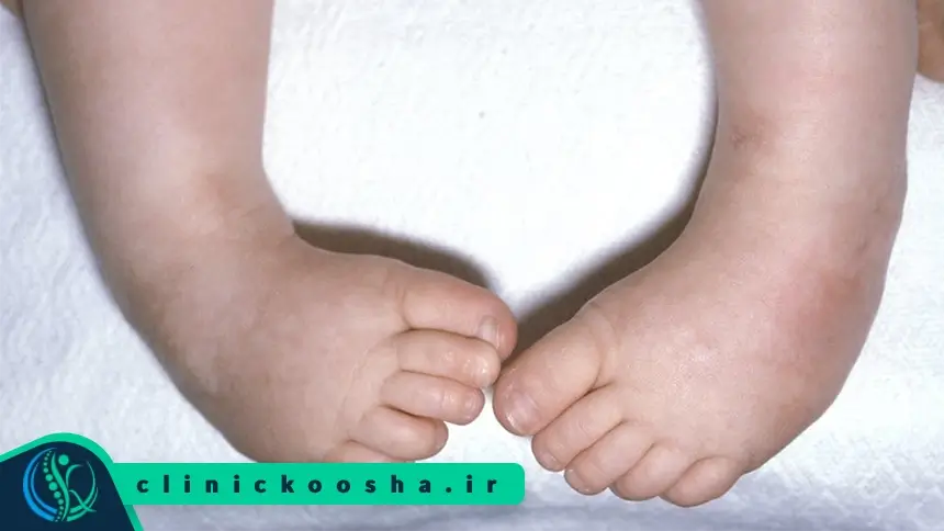 کلاب فوت یا پا چنبری یکی از نقص های مادرزادی است که برای کودکان ممکنه اتفاق میافته
