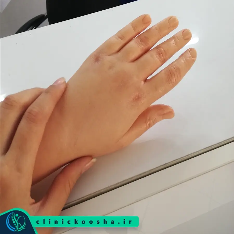 انگشت مصنوعی برای دست یک خانم