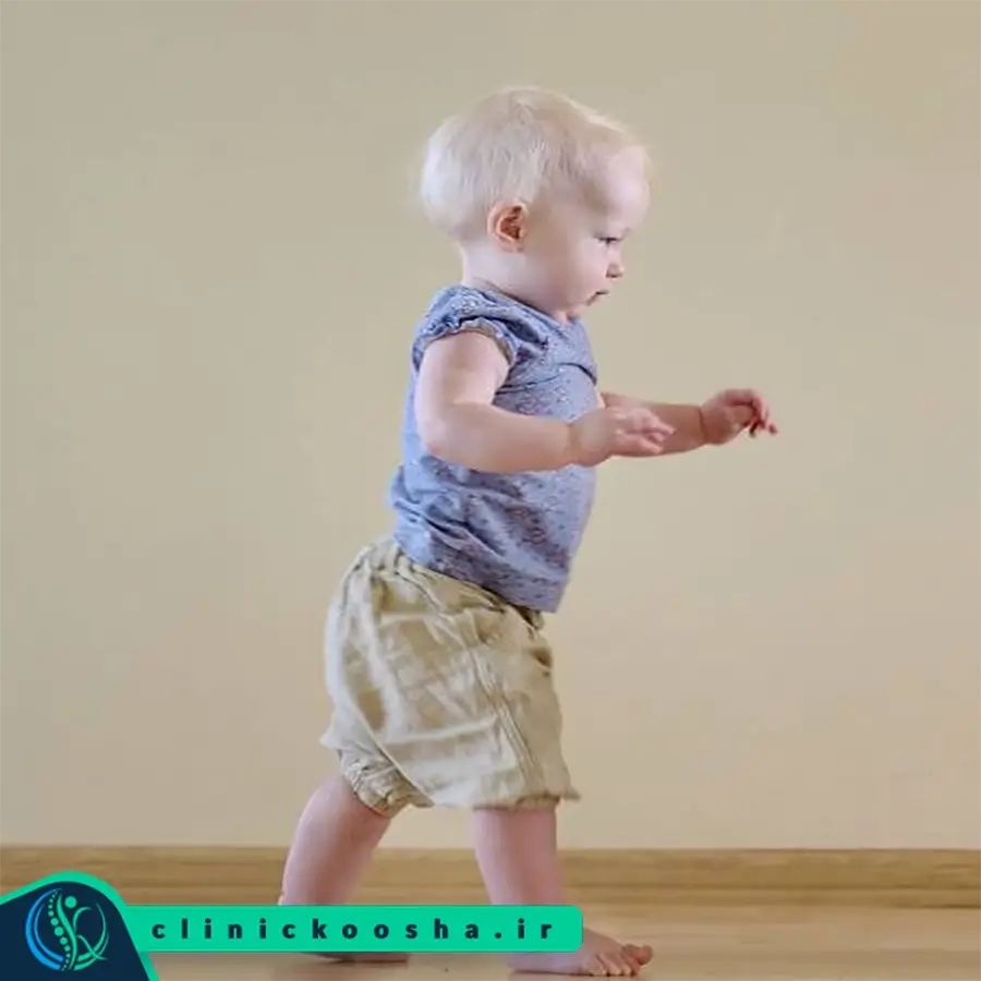 راه رفتن کودک زودتر از زمان طبیعی که موجب انحراف زانو و زانوی پرانتزی شده است