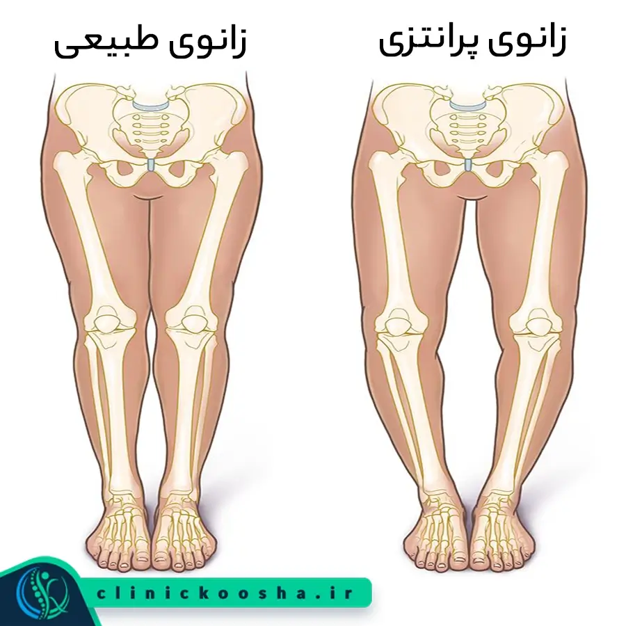 تفاوت استخوان و حالت بدن در زانوی پرانتزی و طبیعی