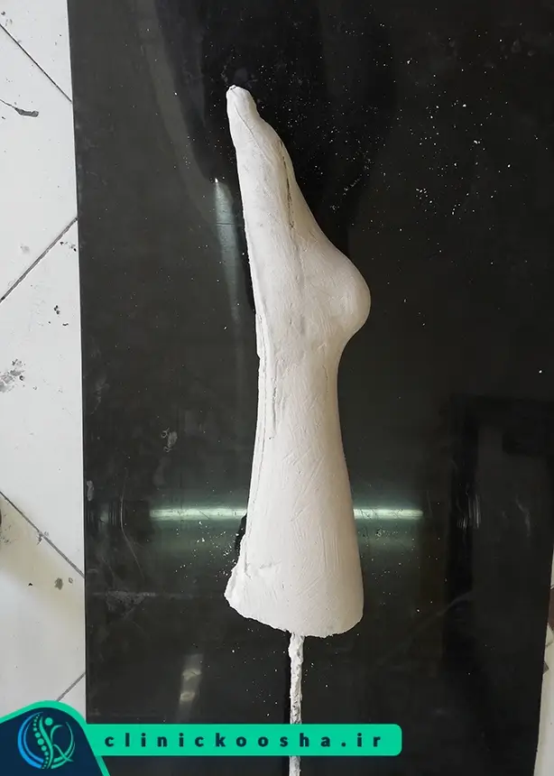قالب‌‌گیری از پا برای ساخت اسپلینت AFO